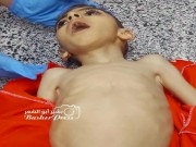 استشهاد طفل بغزة جراء سوء التغذية