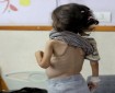 منظمة دولية: حصار غزة يدفع أطفالها نحو الموت البطيء وسوء التغذية