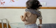 أونروا: أكثر من 2700 طفل في غزة أصيبوا بسوء تغذية حاد