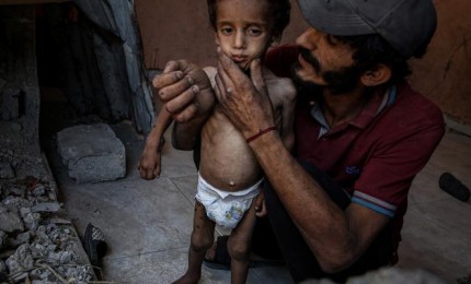 أبو عفش للكوفية: نرصد يوميا انتشار أمراض جديدة في قطاع غزة بسبب سوء التغذية